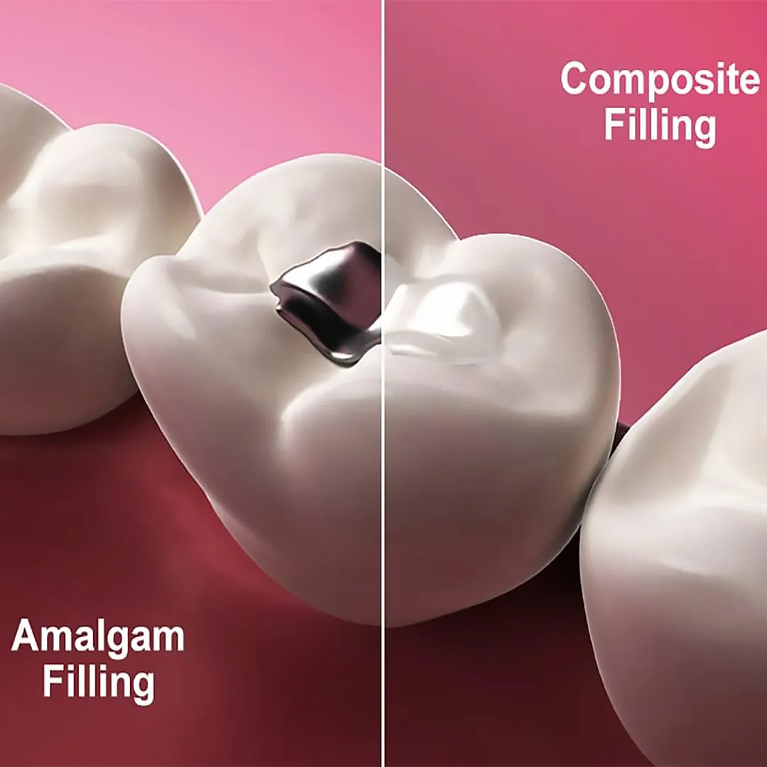 جایگاه کامپوزیت دندان در ترمیمات جزئی و کامل