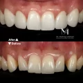 بهترین روش از بین بردن فاصله بین دندان‌ ها در دندانپزشکی زیبایی