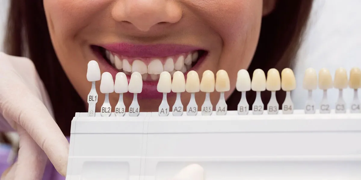انتخاب رنگ لمینیت دندان
