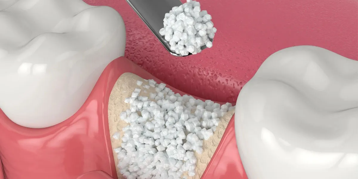 پیوند استخوان در ایمپلنت دندان چیست؟