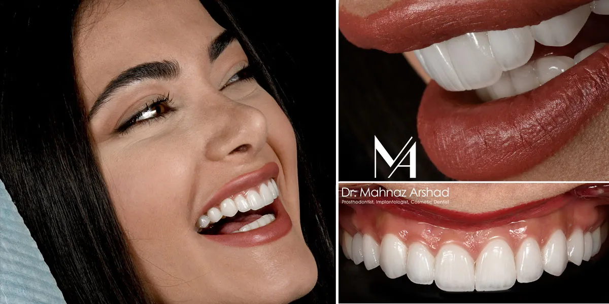 اصلاح طرح لبخند