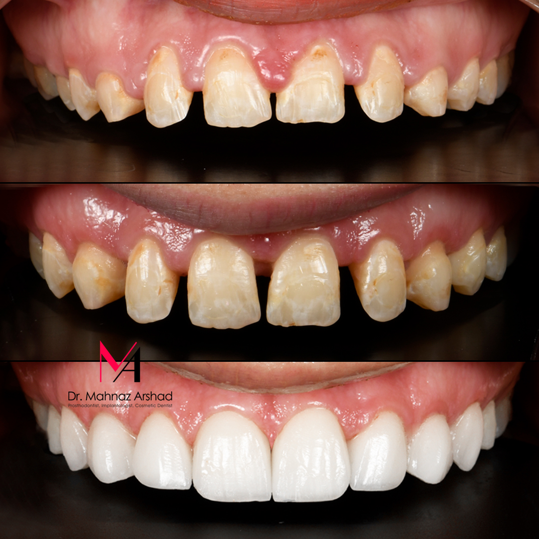 لمینت سرامیکی برای از بین بردن فاصله دندان ها