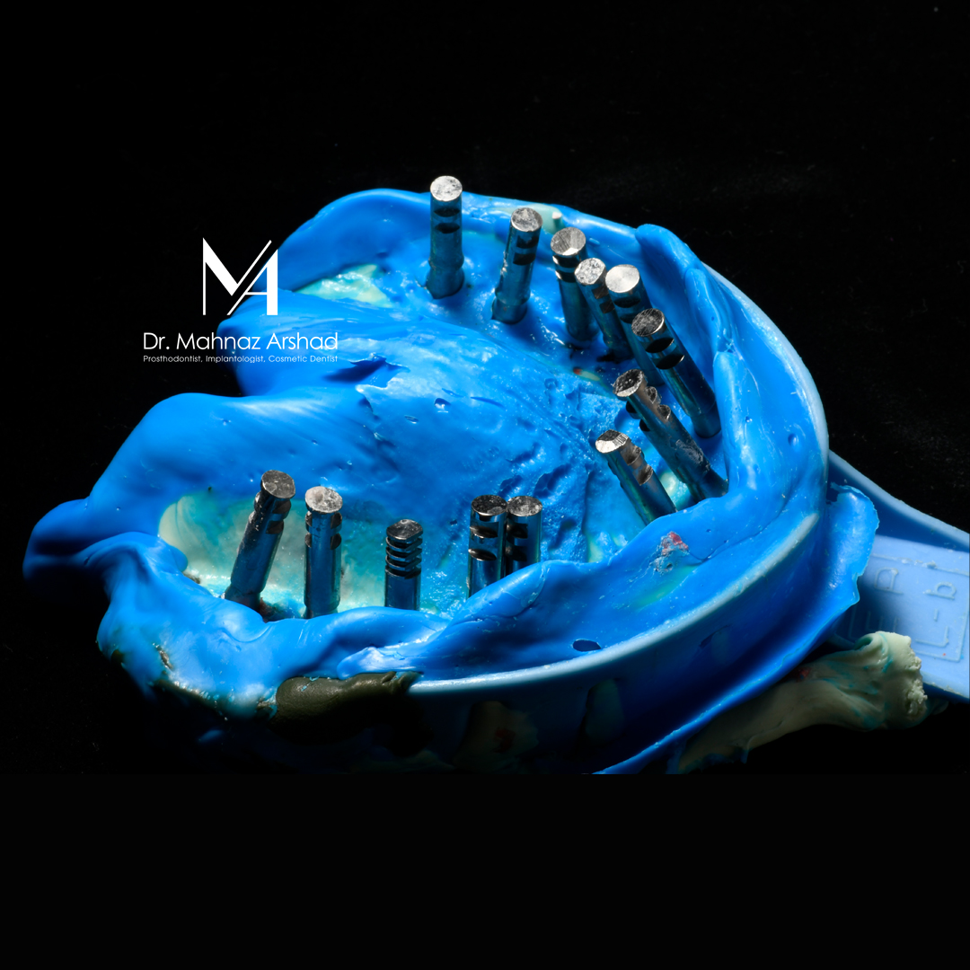 قالبگیری ایمپلنت