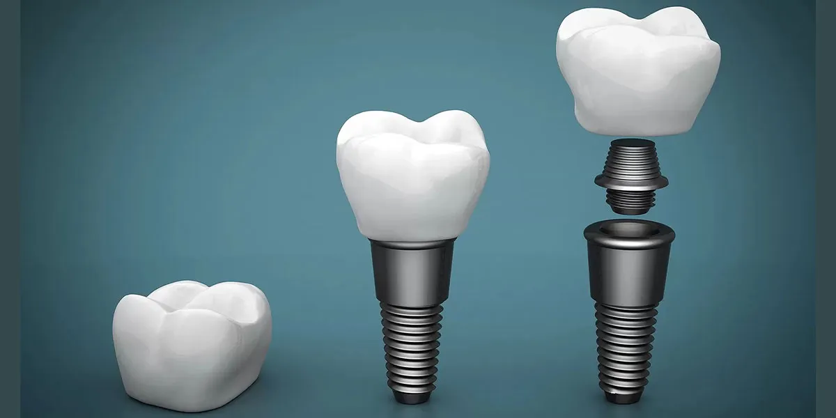 مراحل  ایمپلنت دندان