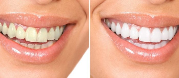 لمینت دندان جهت اصلاح طرح لبخند