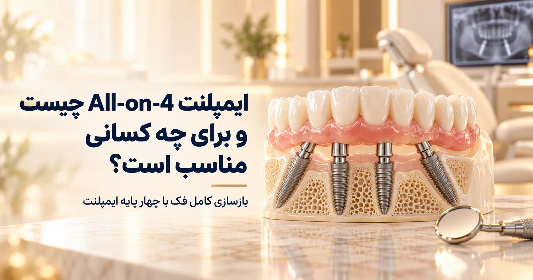 ایمپلنت