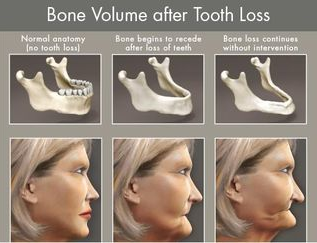 نمای ظاهری فرد بعد از از دست دادن دندان ها