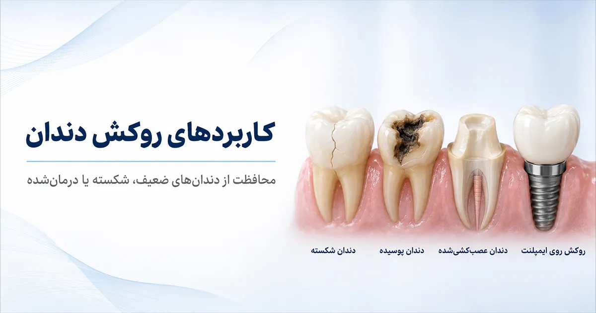 پوسیدگی زیر روکش دندان