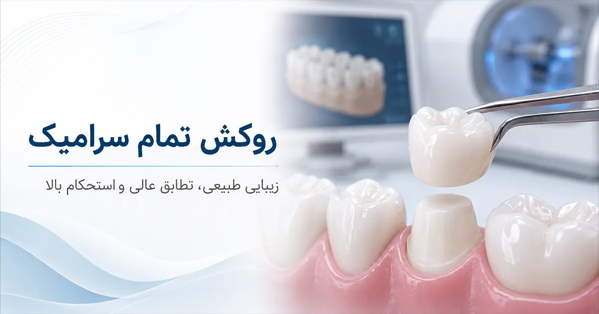 روکش های تمام سرامیک