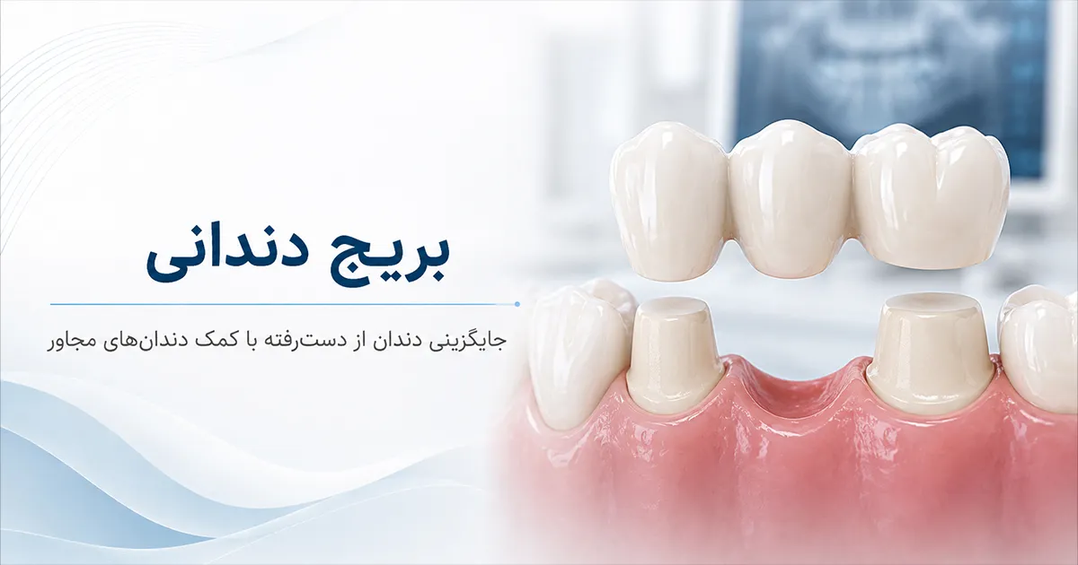 بریج دندان