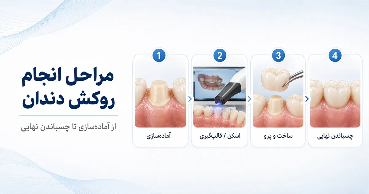 مراحل انجام روکش دندان