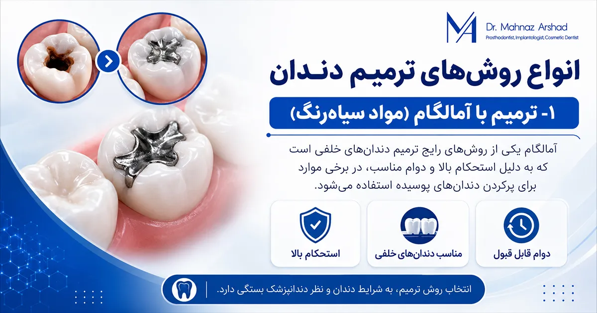 ترمیم دندان با آمالگام