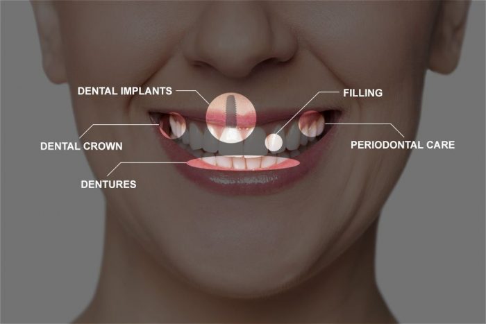 کاربرد ایمپلنت دندان در اصلاح طرح لبخند