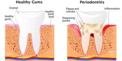 دندانپزشکی برای افراد دیابتی