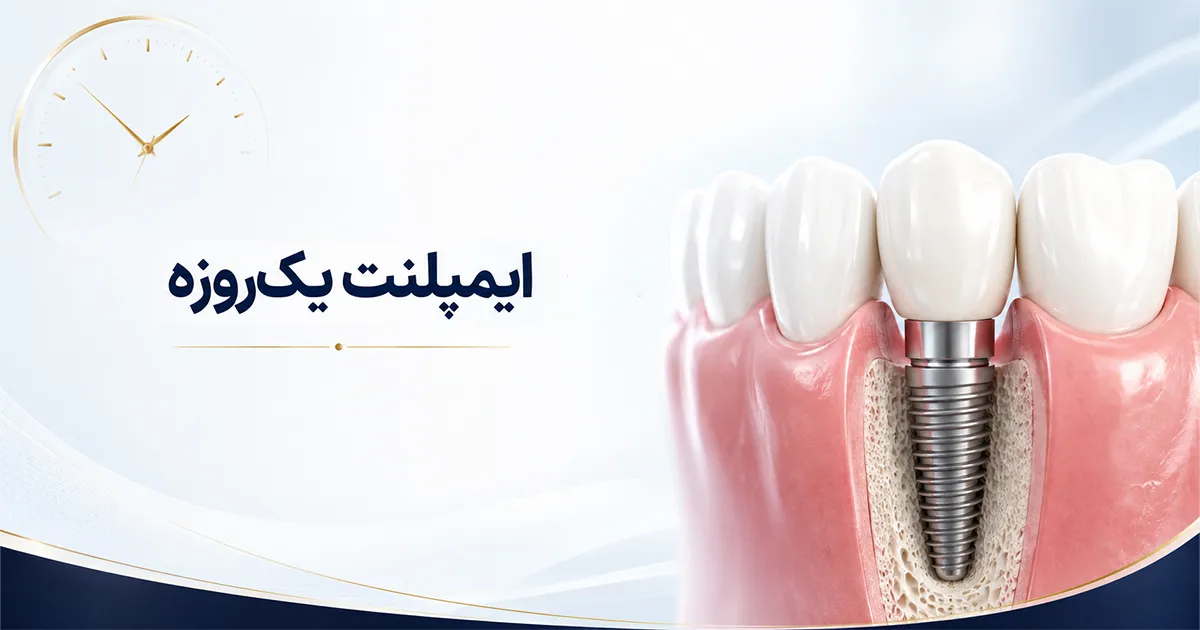 درمان ایمپلنت یک روزه به روش کاملا دیجیتال