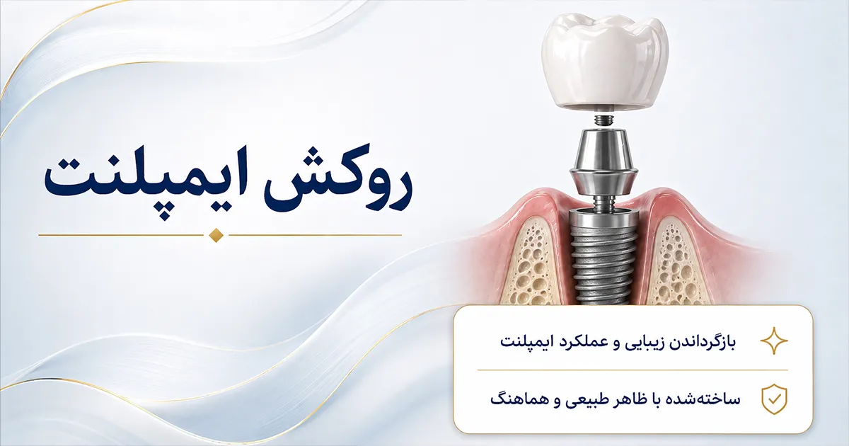 روکش ایمپلنت