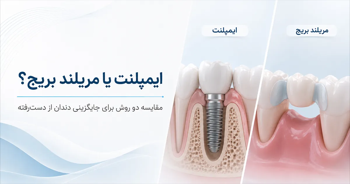 ایمپلنت یا مریلند بریج