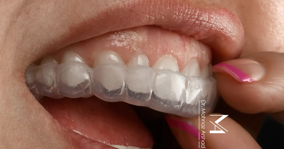 فشار دندان ‌قروچه بر پایه ایمپلنت