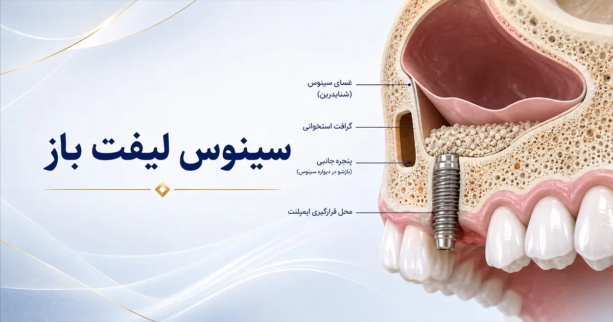 سینوس لیفت باز