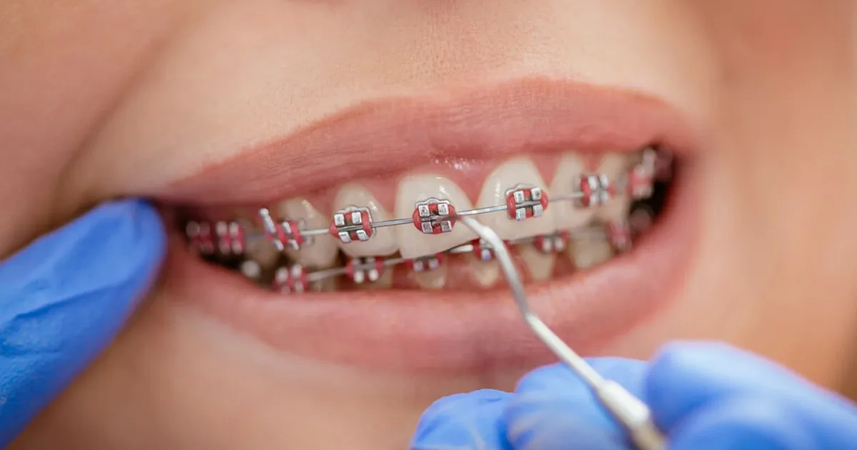 لمینت دندان کج