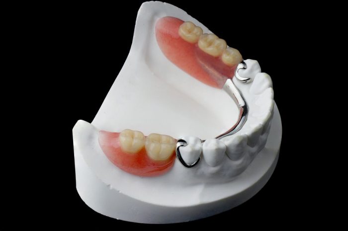 پروتز دندانی پارسیل متحرک با چارچوب فلزی