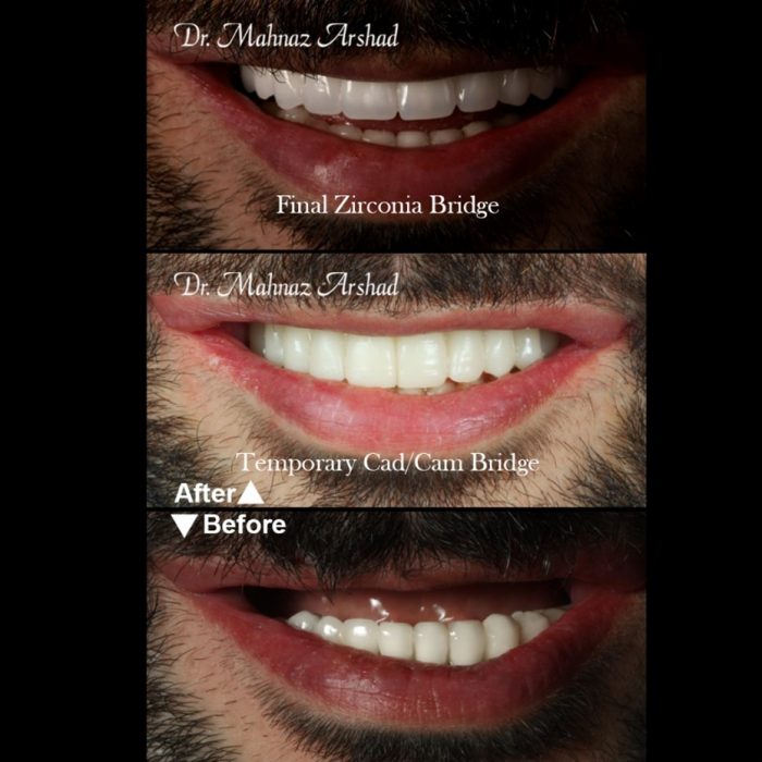 ایمپلنت یکی از روش های زیبایی دندان