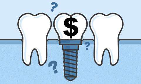 هزینه ایمپلنت دندان چگونه محاسبه می شود؟