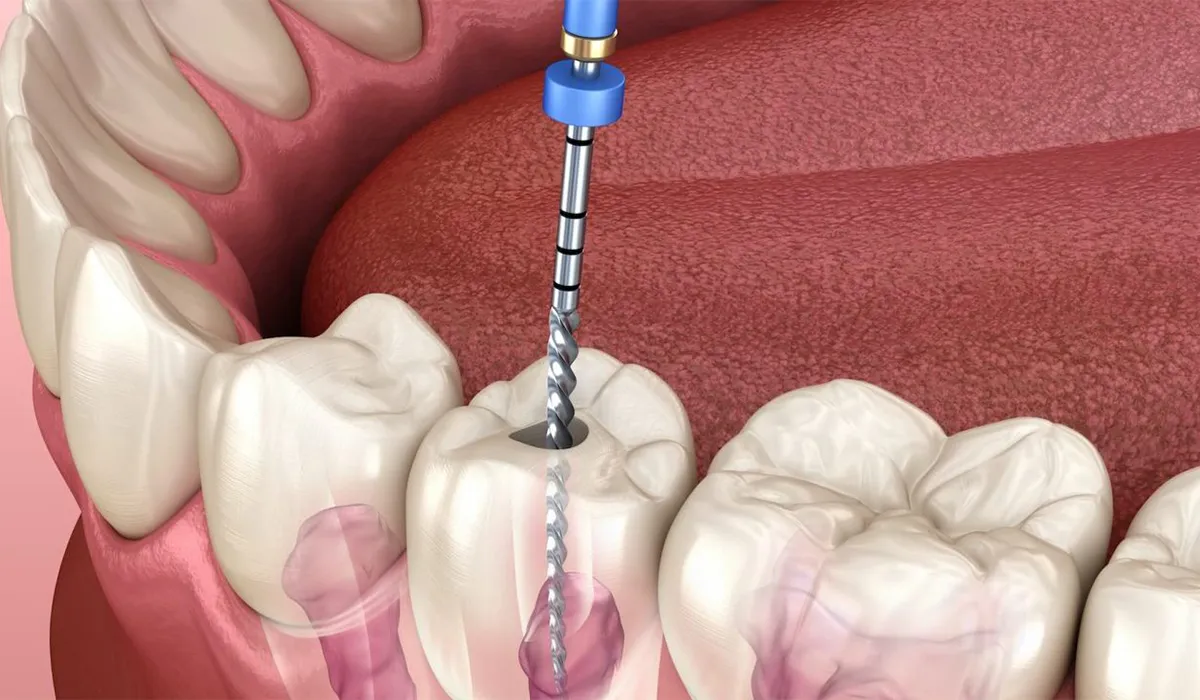 root canal treatment