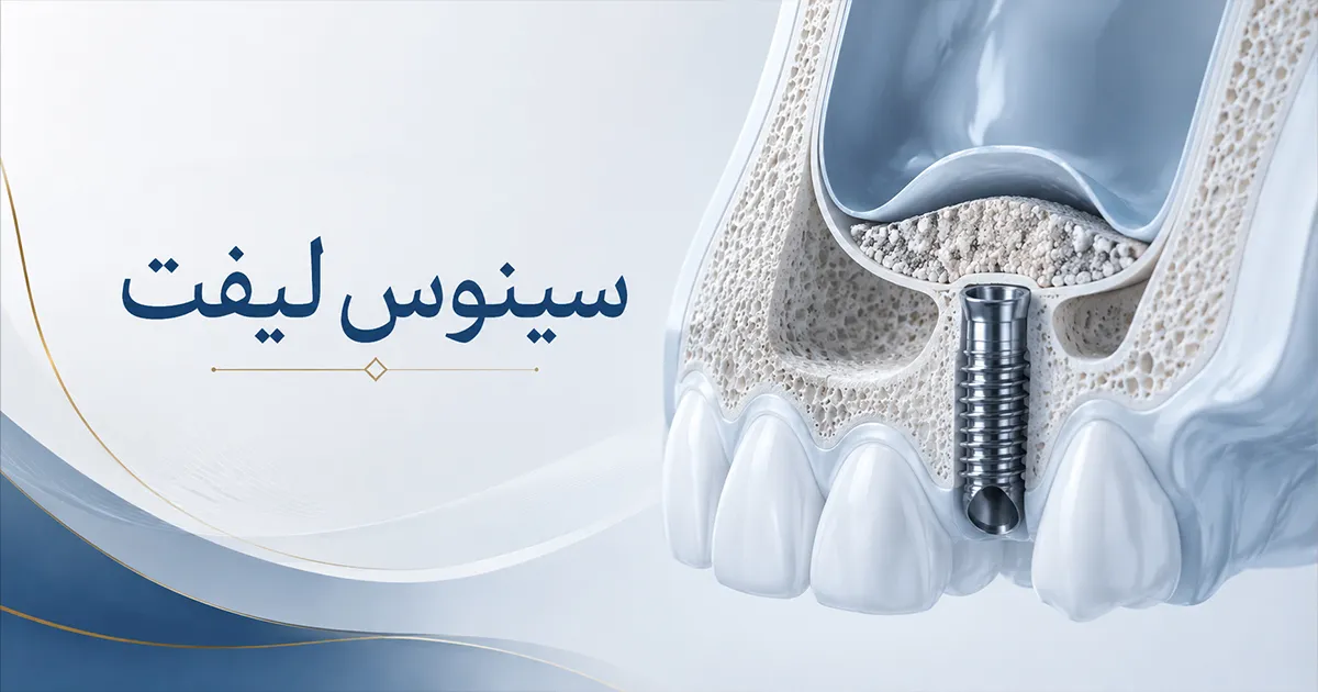 جراحی سینوس لیفت برای کاشت ایمپلنت