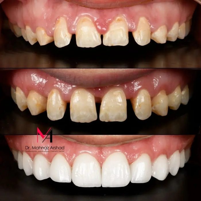 قبل و بعد درمان فاصله دندانی با لمینیت های سرامیکی