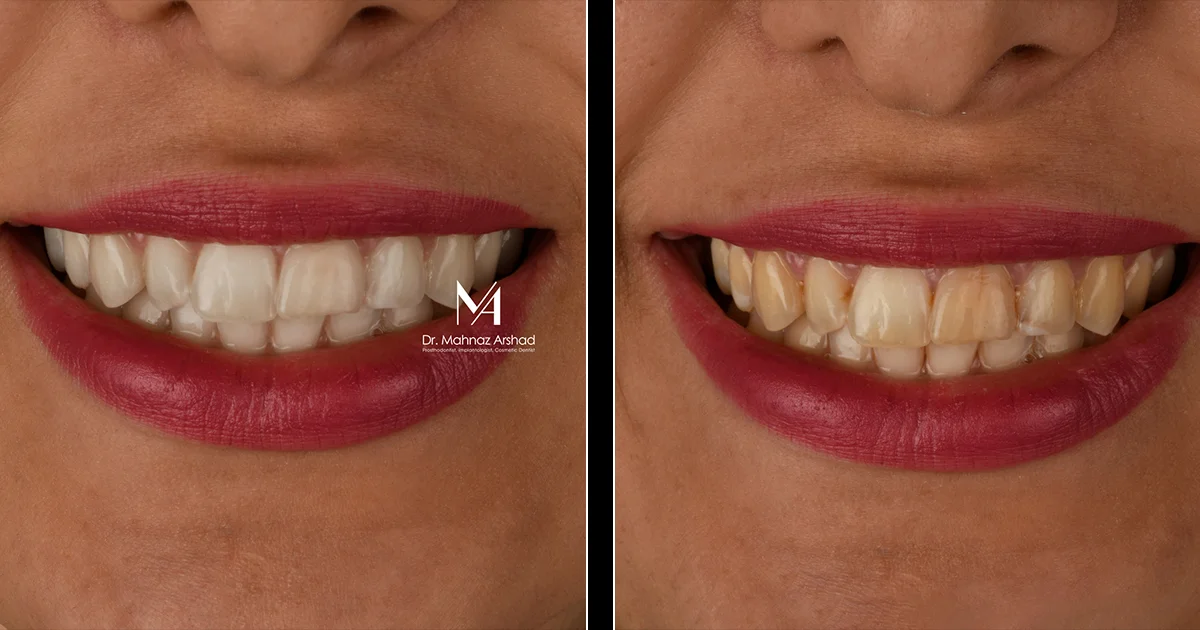 بلیچینگ به مینای دندان اسیب میزند؟