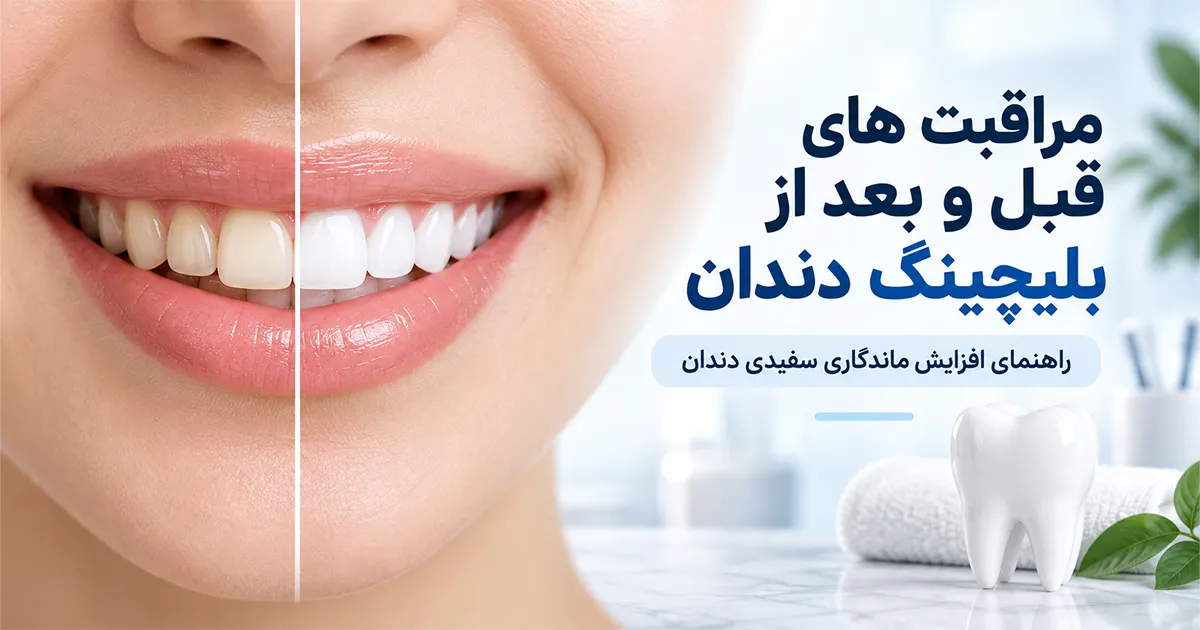 مراقبت های قبل و بعد از بليچينگ