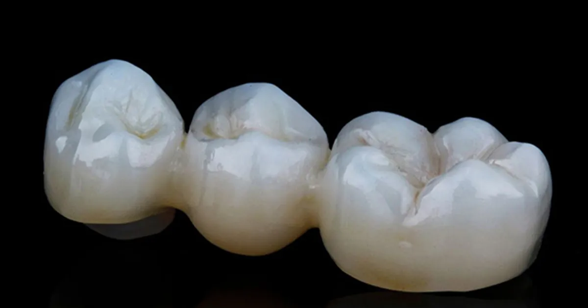 معایب بریج دندان چیست؟