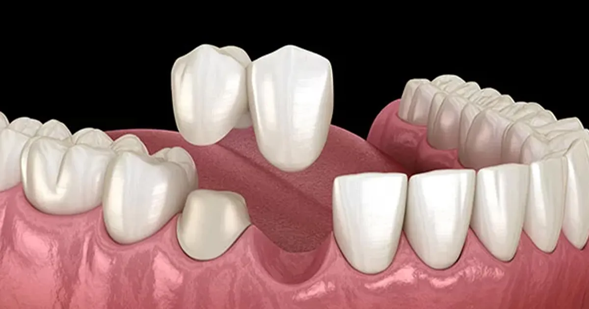 بریج دندان کانتی ‌لیور