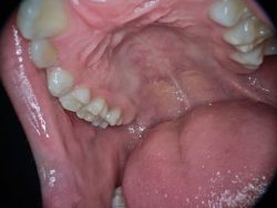 لوکوپلاکیای دندان چیست