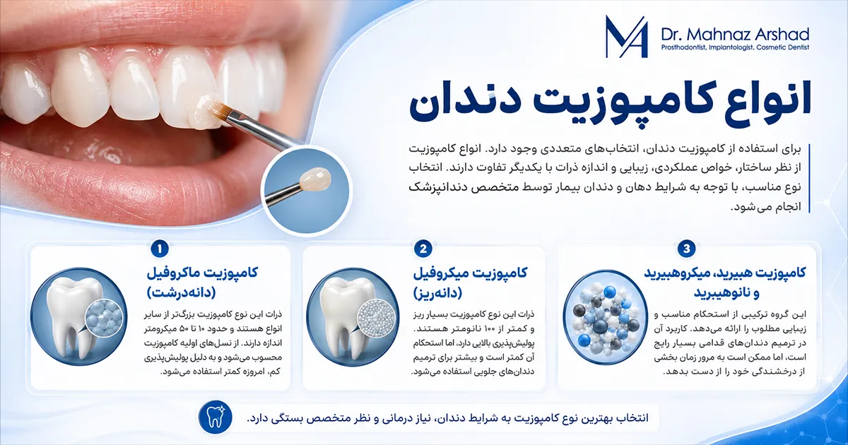 انواع کامپوزیت دندان