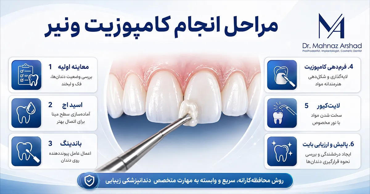 مراحل کامپوزیت دندان