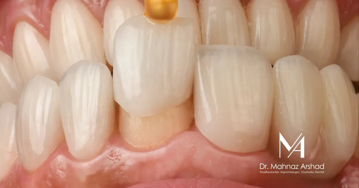 اصلاح طرح لبخند با روکش