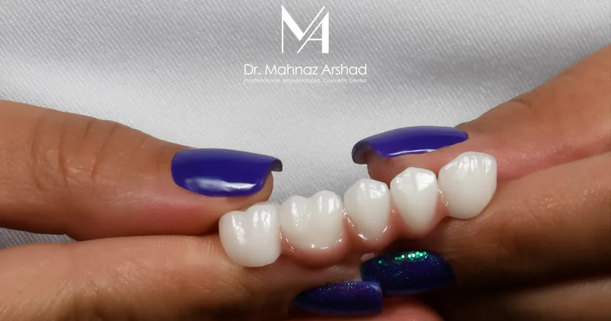 بریج دندان چیست؟ انواع و کسانی که به آن نیاز دارند