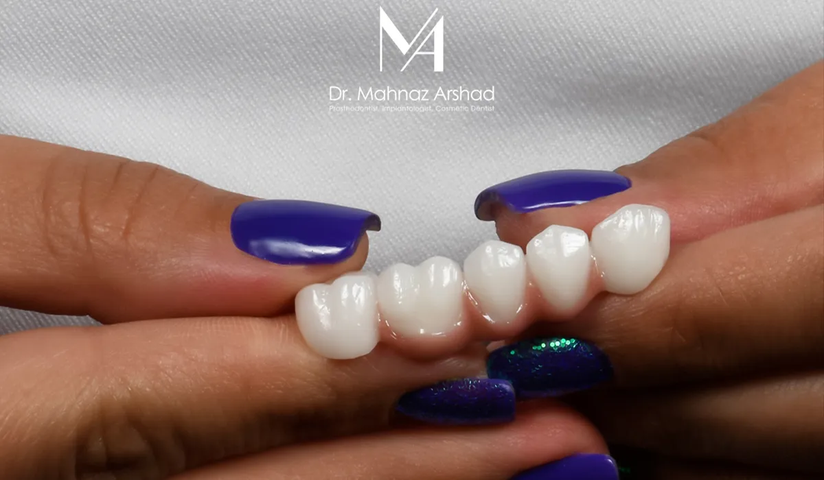 بریج دندان چیست؟ انواع و کسانی که به آن نیاز دارند