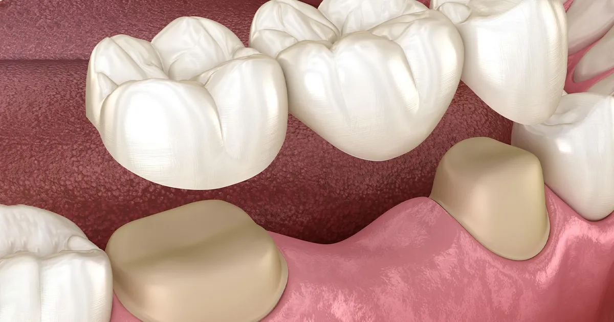 بریج جایگزین دندان از دست رفته