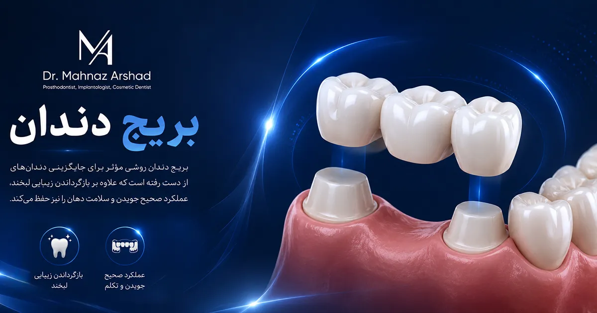 بریج دندان