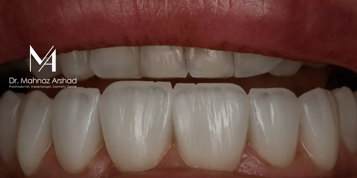 تأثیر کامپوزیت بر سلامت و زیبایی دندان چیست؟