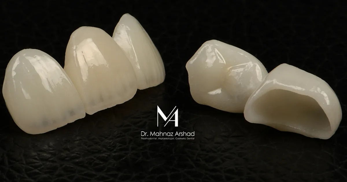 بریج دندان جلو