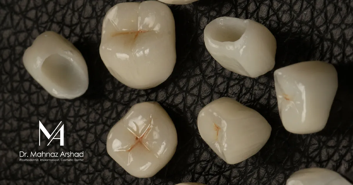 روکش تمام سرامیک