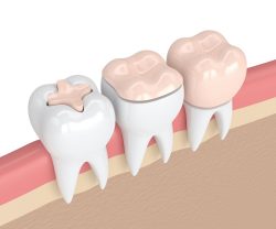بازسازی و ترمیم دندان
