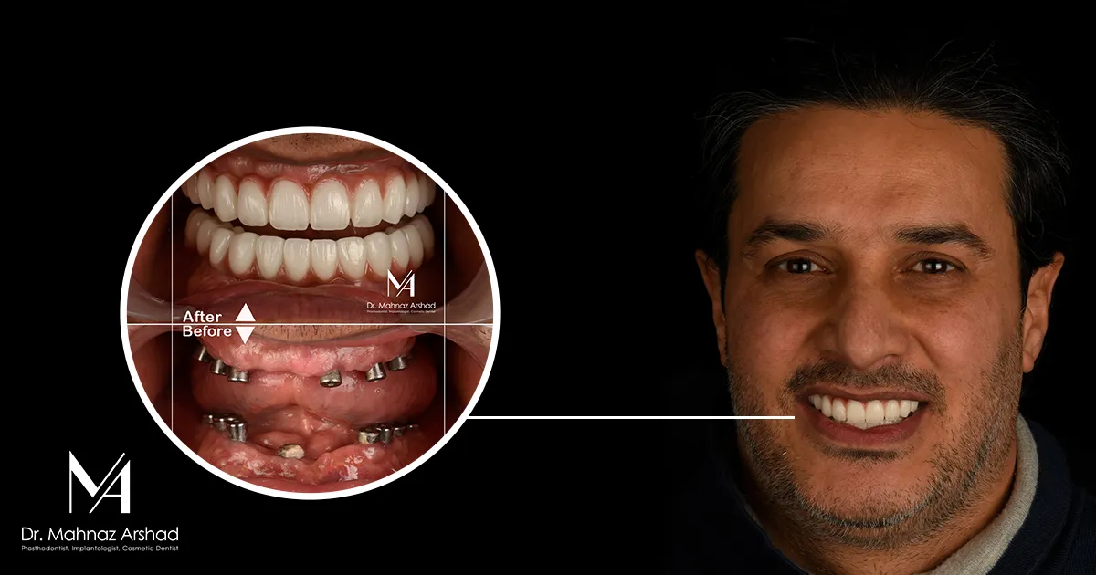 درمان بی‌ دندانی با ایمپلنت؛ راه‌ حل دائمی لبخند از دست‌ رفته