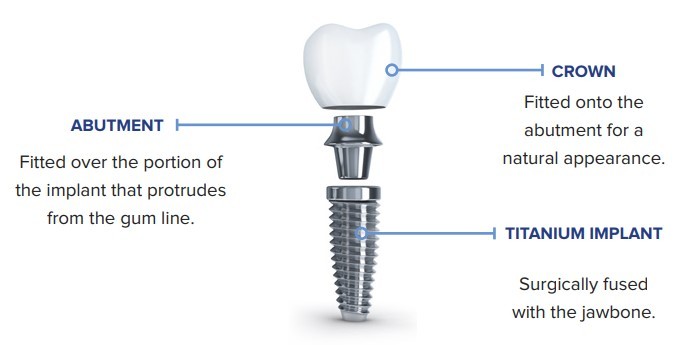 قطعات ایمپلنت دندان