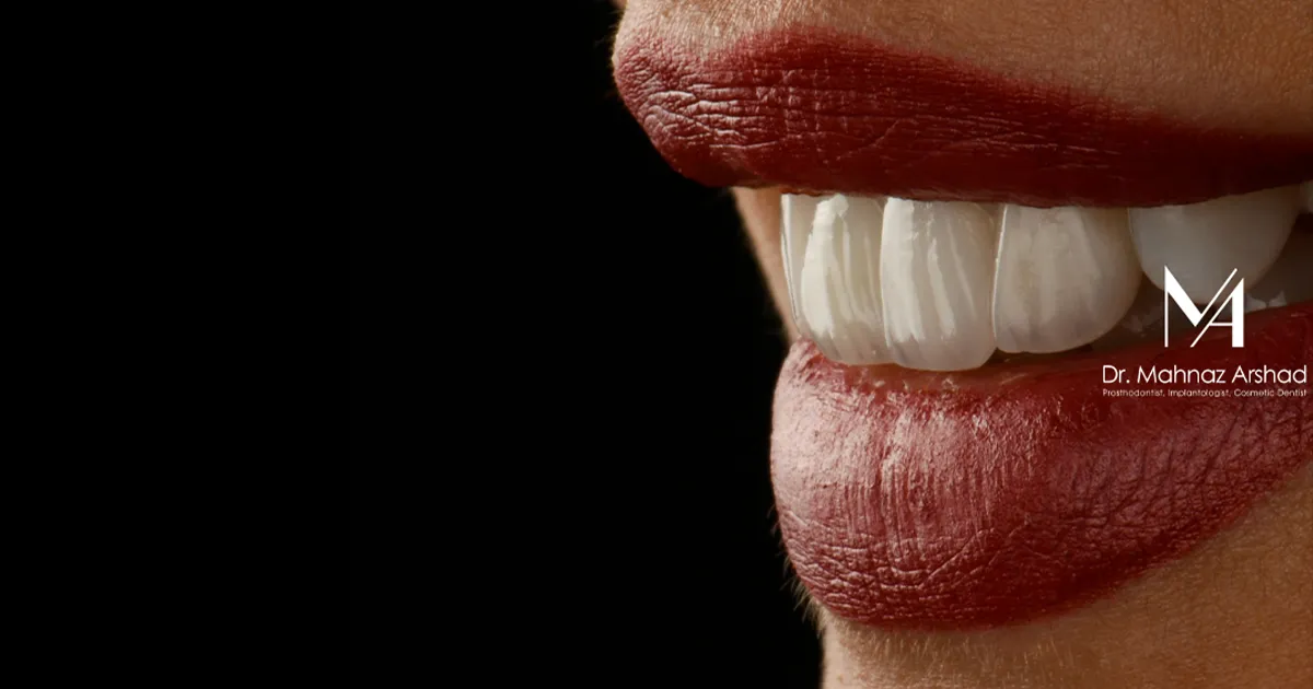 لمینت برای فاصله بین دندان ها