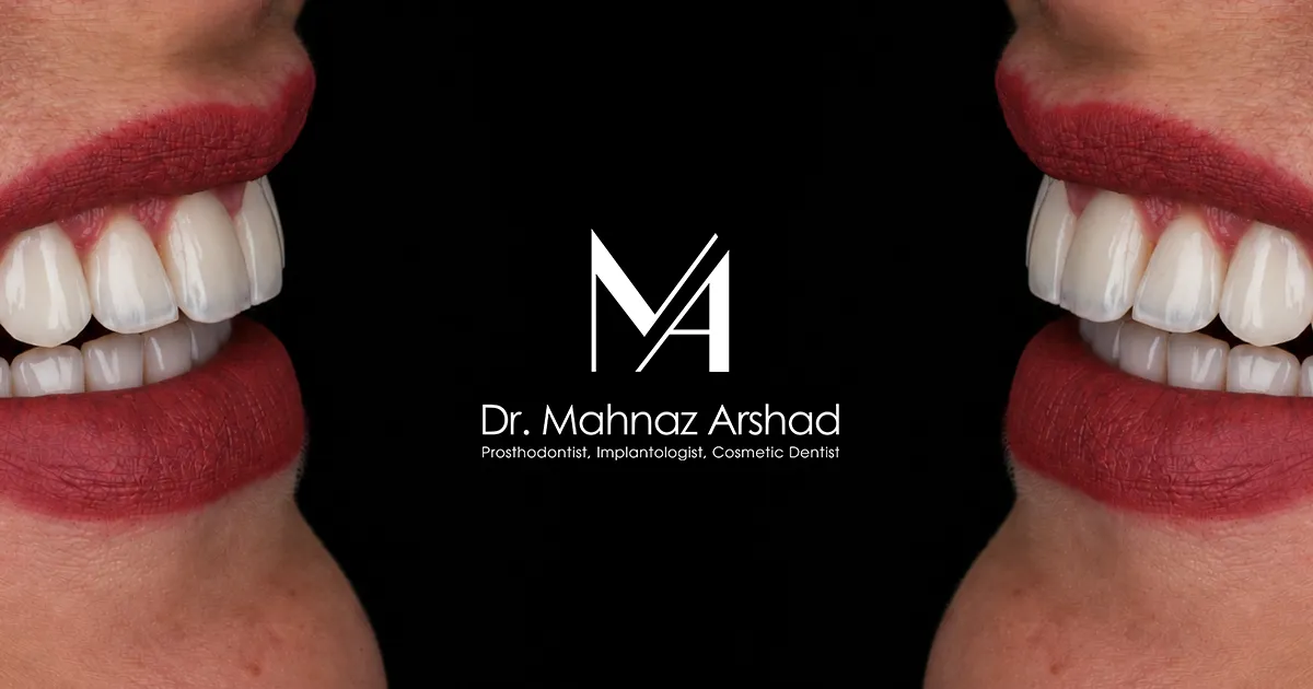 مقایسه لمینیت، کامپوزیت و بلیچینگ